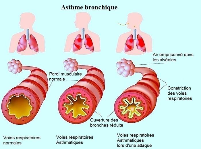Quels sont les personnes à risque de bronchite chronique